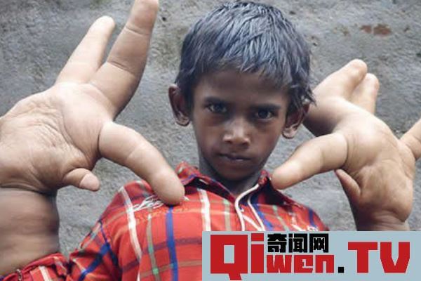 世界罕见巨指症男孩 双手重达12.7公斤 被称诅咒之人